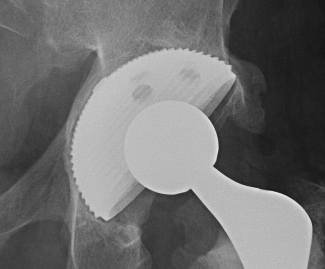 Revision THR IIC Jumbo Cup + medial bone graft